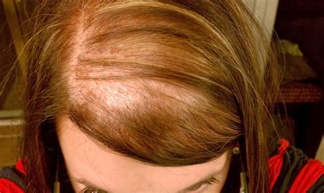 Female Hair Loss Is On The Rise Top And Trend Hairstyle