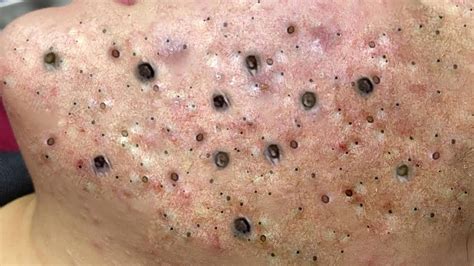 Suri Nguyen Acne Treatment Blackheads Whiteheads Removal Cyst Pimple