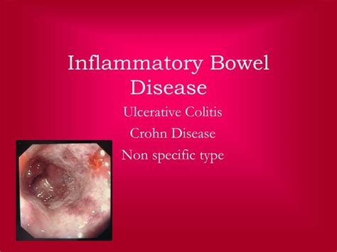 Ppt Inflammatory Bowel Disease Powerpoint Presentation Free Download Id1390427