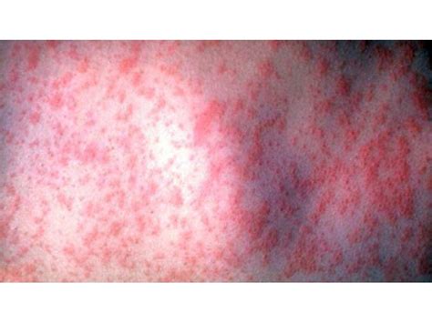 Positive Measles Case Confirmed Possible Exposure Locations Listed