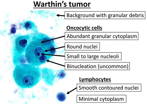 Warthins Tumor Wikiwand