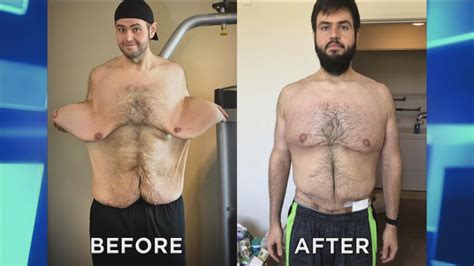 Man Who Lost Over 300 Pounds Returns After Skin Removal