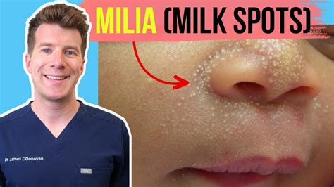 Doctor Explains Milia Aka Milk Spots In Babies And Infants
