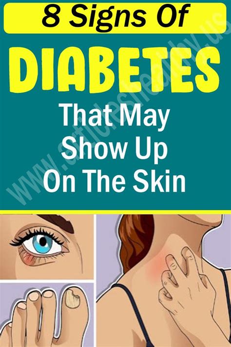 8 Signs Of Diabetes That May Show Up On The Skin Holistic Health Nutrition Health Articles