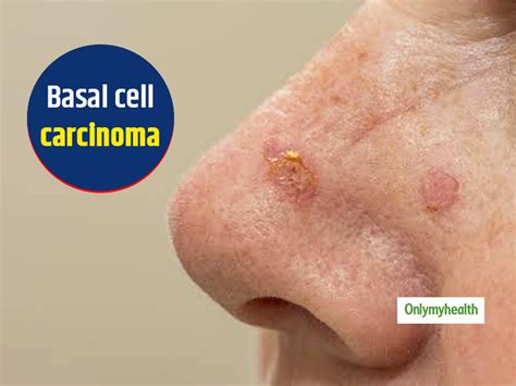 Basal Cell Carcinoma Symptoms Types And Pictures Vrogue