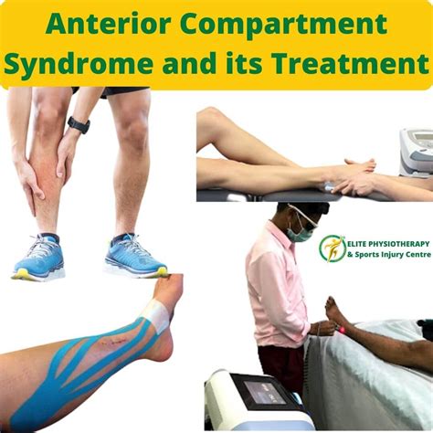 Anterior Compartment Syndrome And Its Treatment Elite Physio