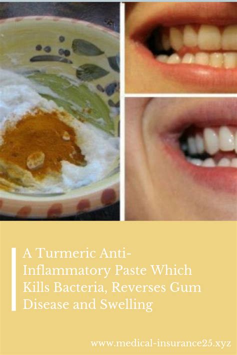 A Turmeric Anti Inflammatory Paste Which Kills Bacteria Reverses Gum