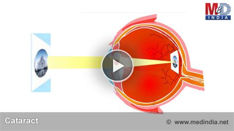 Health Animation Cataract Medindia