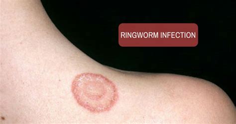 Ringworm In Humans