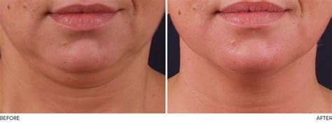 Exilis Elite Skin Tightening And Fat Reduction Skin Deep Aesthetics