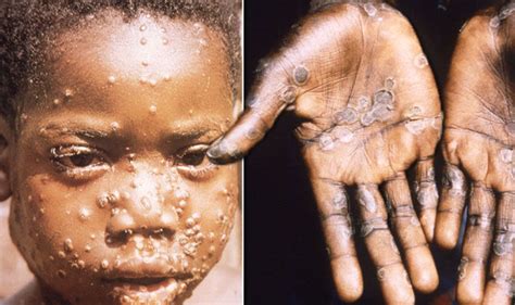 Two clades of the virus are recognized: Monkeypox Warning: First case in Singapore & Everything ...