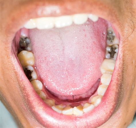 If you find your breath is bad even when you haven't eaten, this could be a sign of cavity. Will a Cavity Heal Itself Over Time?