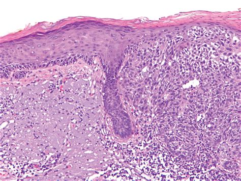 Hyperkeratotic Actinic Keratosis