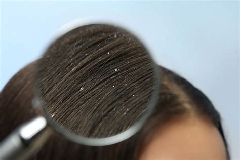 Types Of Dandruff And How To Tackle Each Be Beautiful India