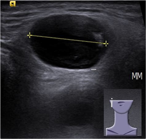 Primary Parotid Gland Lymphoma Pitfalls In The Use Of Ultrasound Imaging By A Great Pretender