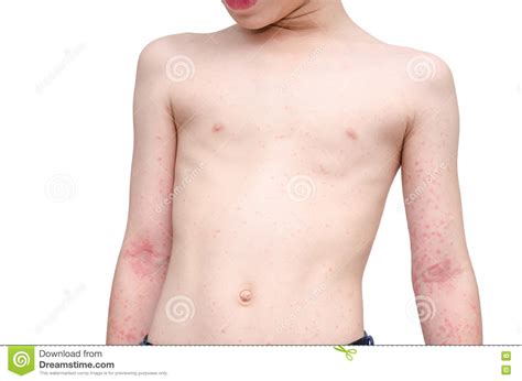 Child Skin With Rash Over White Stock Photo Image Of Medicine Person