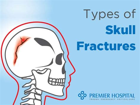 Types Of Skull Fractures