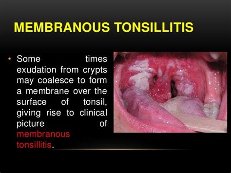 Bacterial Laryngitis Nhs White Tonsil Cyst V Alert Vrtl T Tonsil