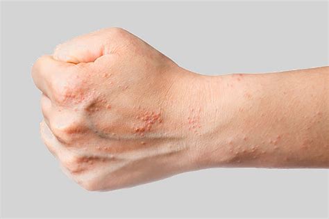 Eczema Fist New Allergy Medik