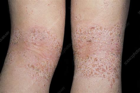 Atopic Dermatitis Behind The Knees Stock Image C0119515 Science