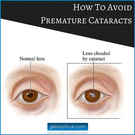 Adding a variety of colorful fruits and vegetables to your diet ensures that you're getting many vitamins and nutrients. How To Avoid Premature Cataracts | The GKB Eyewear Destination