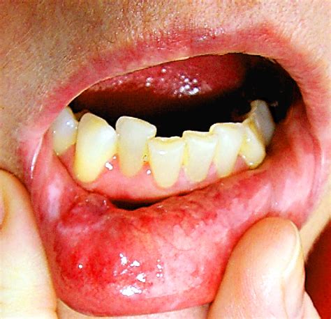 Herpes On Bottom Lip Pictures Photos