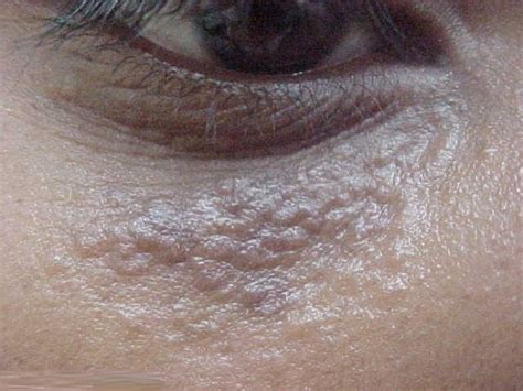 Syringoma Treatment Removal Symptoms Pictures Causes Under Eye