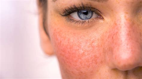 Successfully Treating Rosacea The Excel V Laser Is Best
