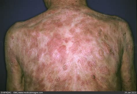 Stock Image Mycosis Fungoides On A Patients Back This Is A Rapidly