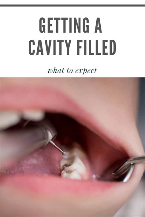 Cavities in your teeth can cause the top layers of them to wear down. What to expect with you have a cavity in 2020 | Cavity ...