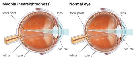 Myopia Laservision Victoria