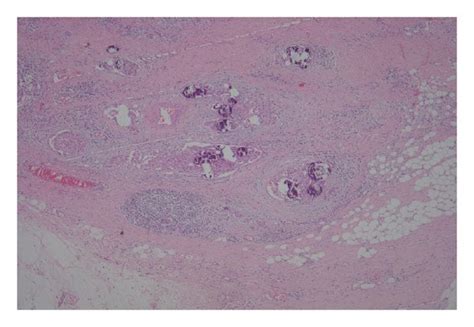The Lymph Nodes Exhibit Metastatic Papillary Carcinoma Of The Classical