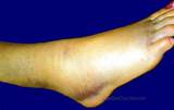 Images of Toe Strain Treatment