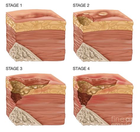 Stages Of A Bedsore Illustration Photograph By Gwen Shockey Pixels