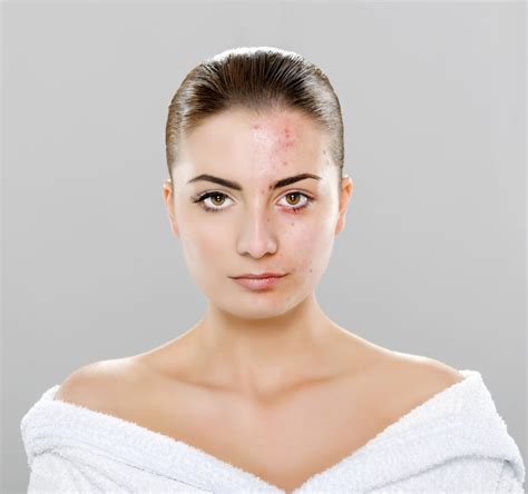 What Is Acne Faq The Spa At Ancaster