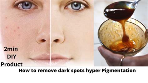 How To Get Rid Of Dark Spots And Pigmentation Diy Simply Remedy Best
