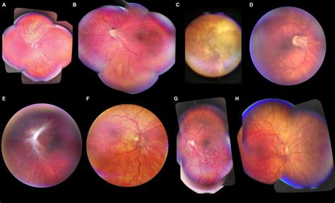 Representative Diagnostic Quality Photographs Of Retinal Abnormalities