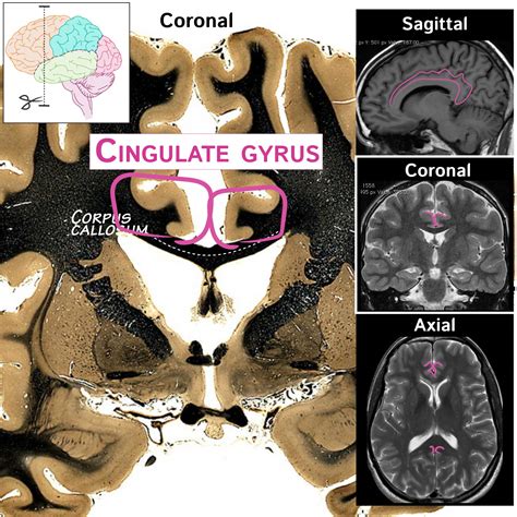 Neuroanatomy Glossary Cingulate Gyrus Ditki Medical And Biological