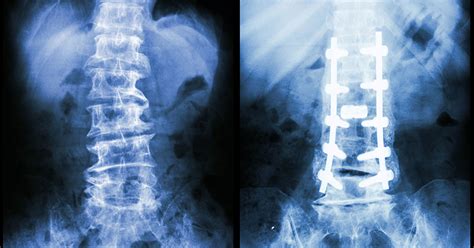 Lumbar Pedicle Screw Fixation Seattle Wa Brain And Spine Surgery