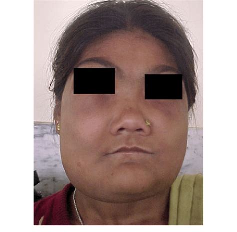 Front View Of A Patient With Cherubism Showing Massive Expansion Of All Download Scientific