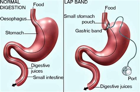 Bariatric Surgery Corpus Christi Better Weigh Center