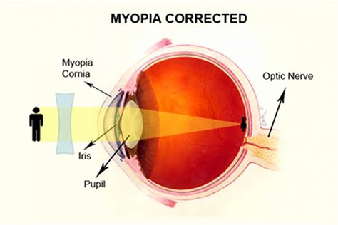 Myopia Control A Cure For Nearsightedness Eye