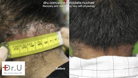 Video Los Angeles Patient Finds Cure For Akn Razor Bumps On Head