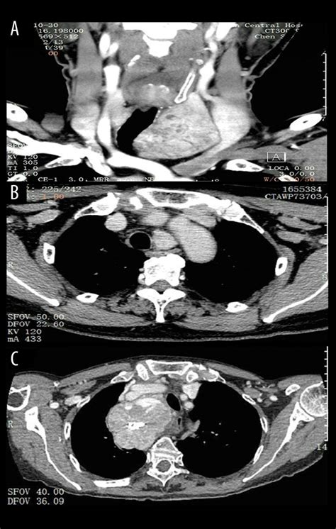 Medical Science Monitor Surgical Management Of 48 Patients With