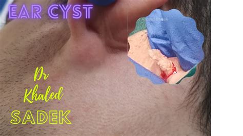 Massive Ear Cyst Removal Dr Khaled Sadek LipomaCyst Com YouTube