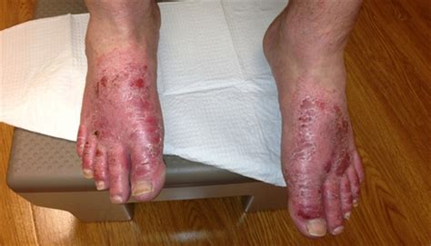 An Itchy Rash On The Feet Clinical Advisor