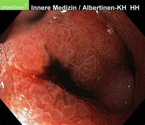 Duodenitis