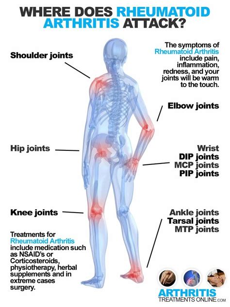 Arthritic Hip Pain Location Chart