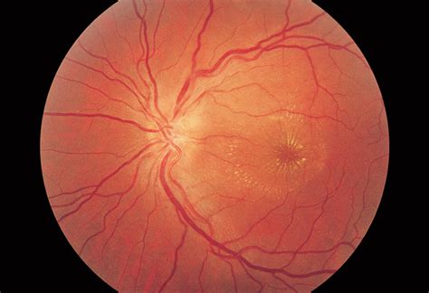 Macular Star In Neuroretinitis Ophthalmology Jama Neurology Jama