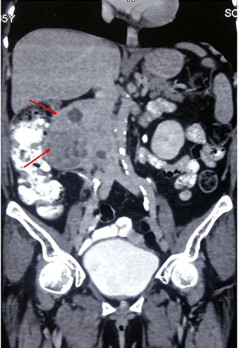 Computed Tomography Ct Of The Abdomen Coronal Image Showing A
